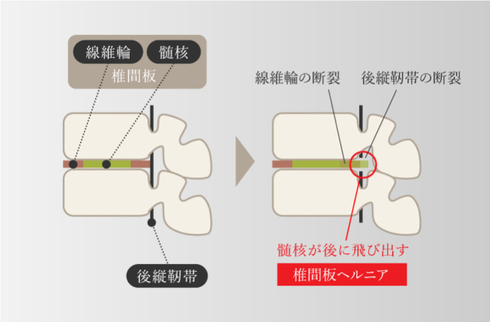 椎間板ヘルニア