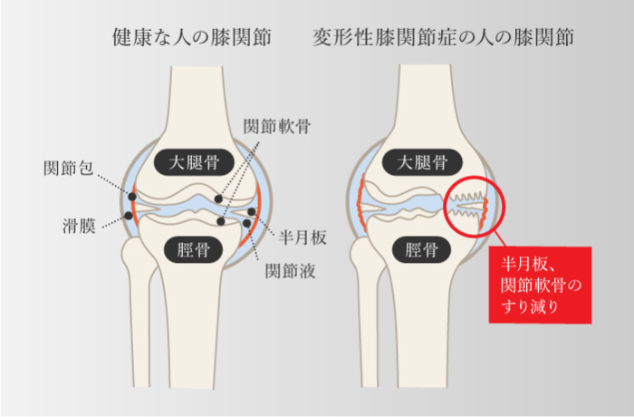 変形性膝関節症