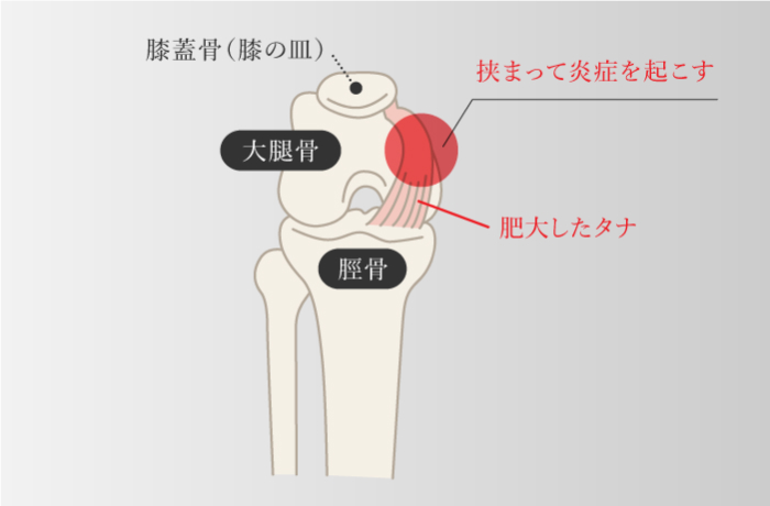 滑膜病変・棚障害
