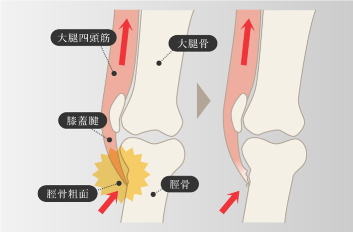 オスグッド・ＳＬＪ