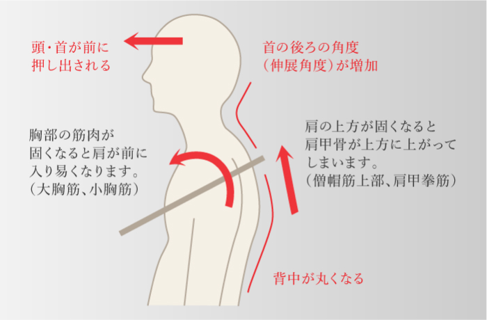 前方頭位・上位交差性症候群