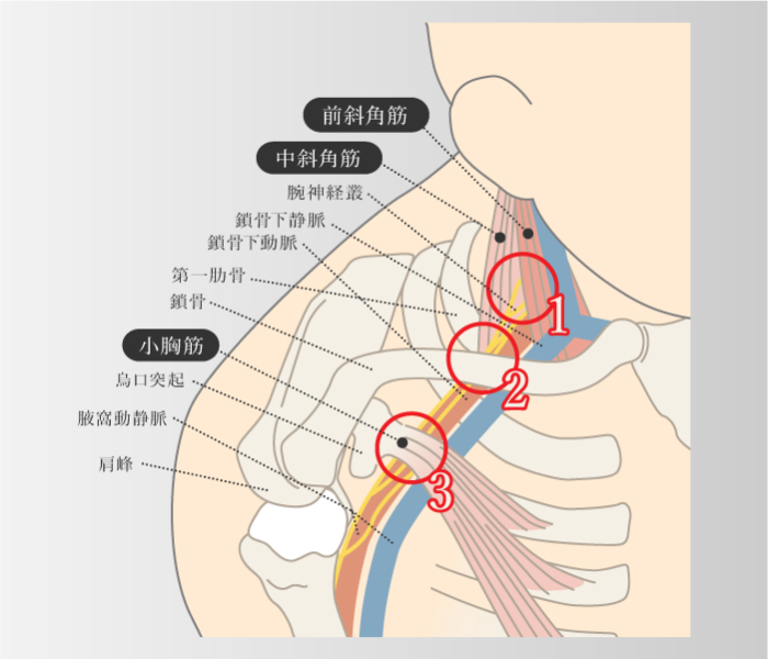 胸郭出口症候群