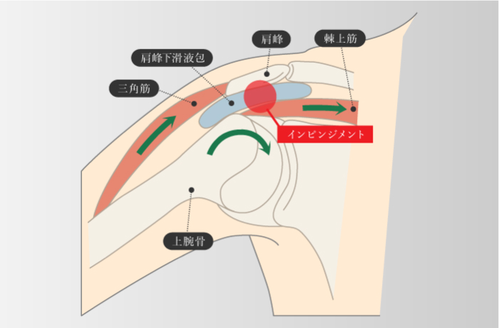 インピンジメント症候群