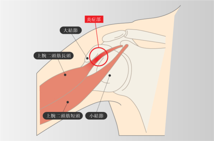 上腕二頭筋長頭腱炎
