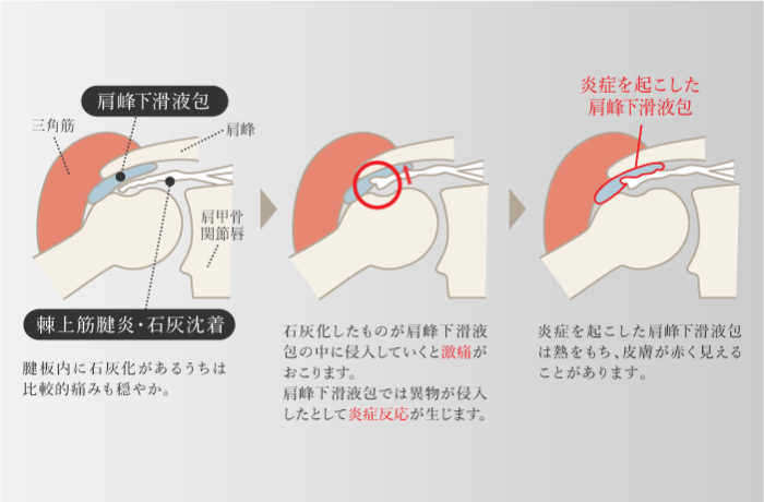 石灰沈着性腱板炎